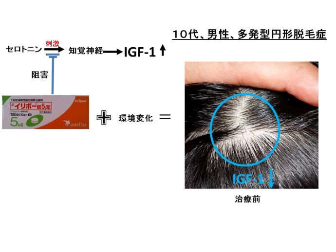 円形脱毛症　病院